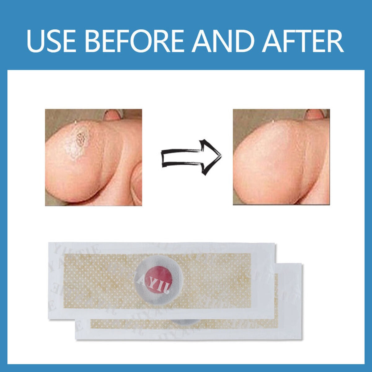 6Pcs Corn Remover Pads With tool